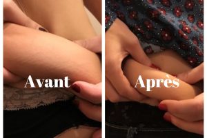 Cryolipolyse avant après à l’Instant beauté : Mon test et mon avis (photos)