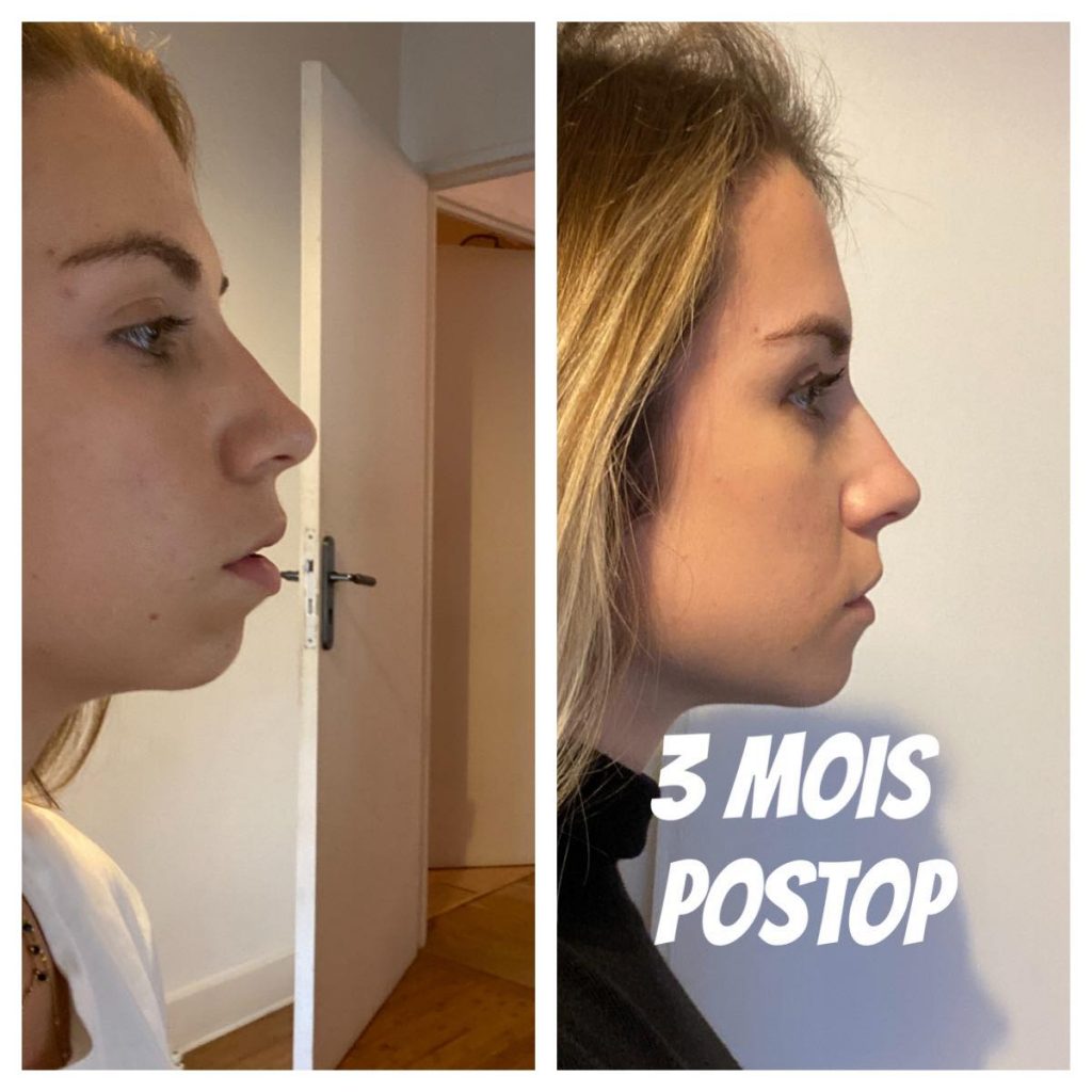 génioplastie avant après 3 mois post op